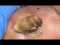 [ASMR] Sharp Ingrown Trimmed! Professional Pedicure DR LEE’S ULTIMATE ZITPOPPER 0509IP8 IMG 4689
