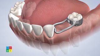 Spacers in Amarillo TX | AOMS Pediatric & Children's Dentistry