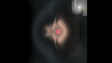Perturbed density structure in a high mass X-ray binary by the shadowed wind