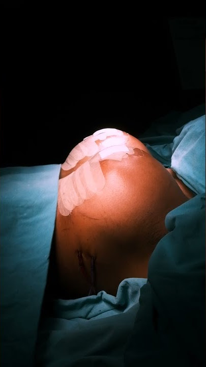 Breast Implant Reels