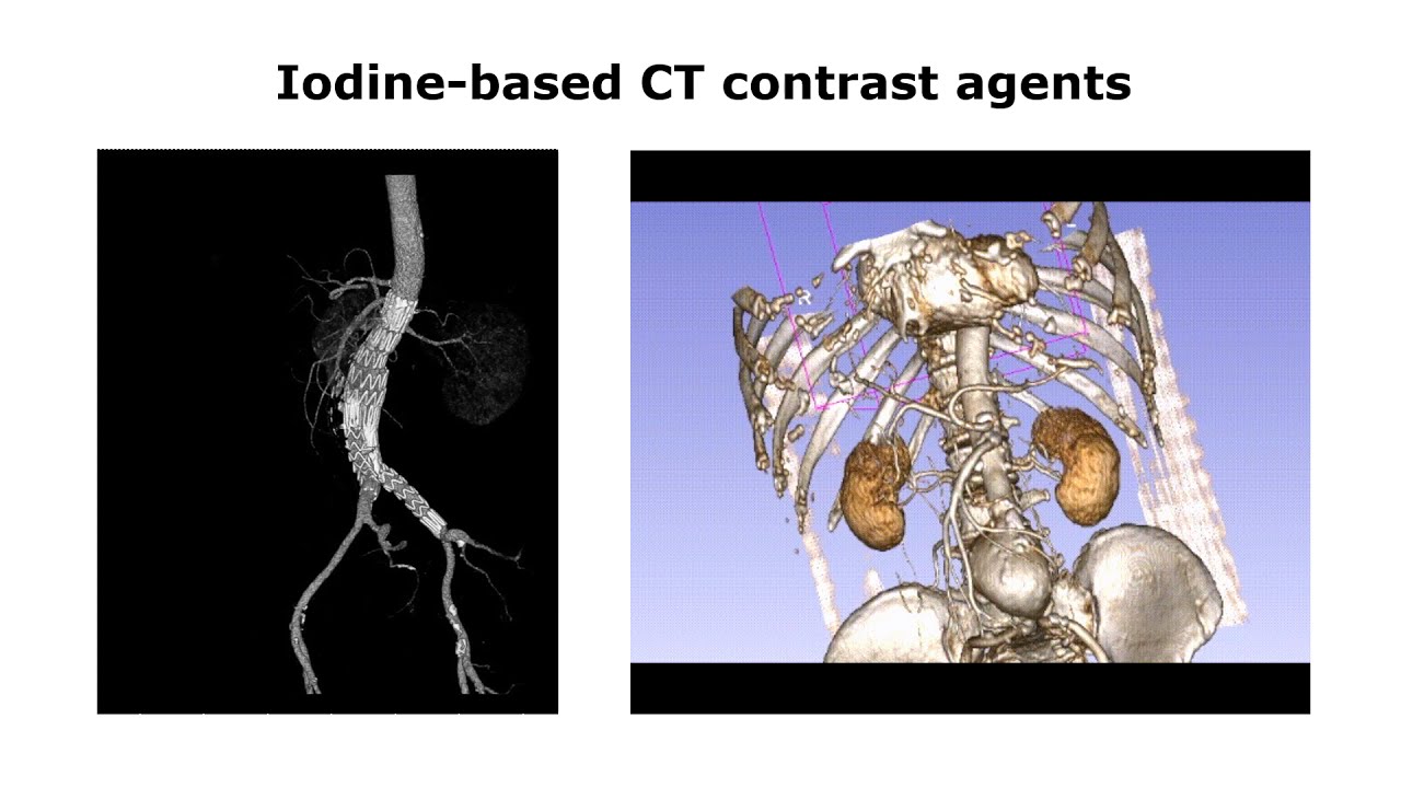 VIDEO ABSTRACT: CT imaging of gold nanoparticles in a human‐sized ...
