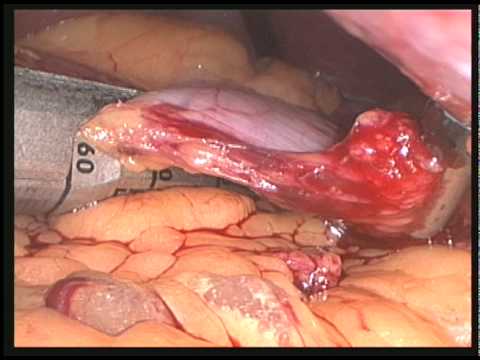 Gastric Sleeve Video (Sleeve Gastrectomy)