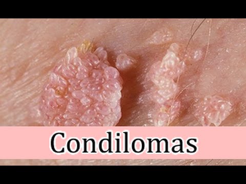 como las celebridades comienzan a salir los condilomas