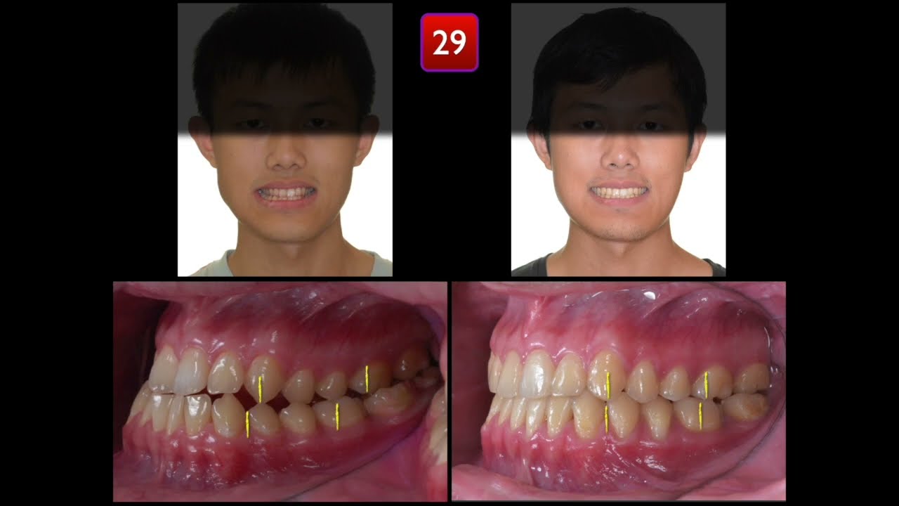 Skeletal Class III with functional shift | 【Chris Chang Ortho】CC822