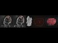 Using MRI to Visualize the Placenta