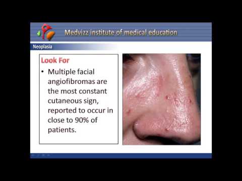 Video: Multiple Endocrine Neoplasia Tipe 1: Analisis Ekstensif Dari Basis Data Besar Pasien Florentine