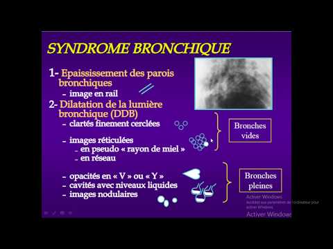 Vidéo: Prévalence Et Incidence Des Bronchectasies En Italie