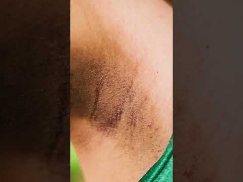 كيفية إزالة السواد تحت الإبط