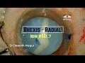 Rhexis has gone radial   now what   understanding the flap motility sign dr depak megur