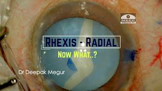 Rhexis has gone Radial   Now What  ? Understanding the Flap Motility sign .Dr Depak Megur