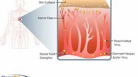 Shingles Pathophysiology - DayDayNews