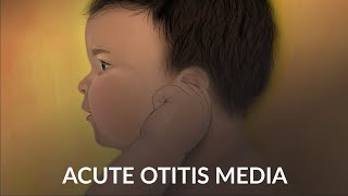 'Acute Otitis Media' by Alex Ruan and Jennifer Cheng