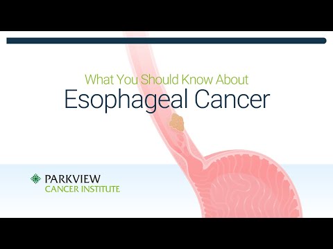 What You Should Know About Esophageal Cancer