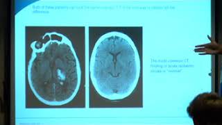 FAST-ED Stroke Presentation