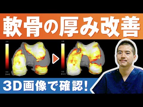 膝の再生医療】医師が解説! 治療前後の膝を360°覗いてみたら? - YouTube