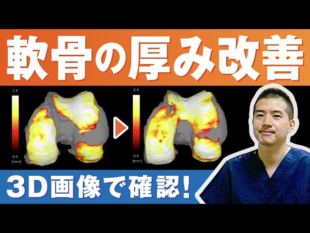 膝を診る目 診断・治療のエッセンス 名医の目のつけどころ 膝の再生医療】医師が解説! 治療前後の膝を360°覗いてみたら? - YouTube