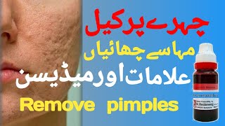 chehre ki chaiyan khatam karne ka tarika》chehre ke dane khatam karne ka tarika》remove pimples》abbas