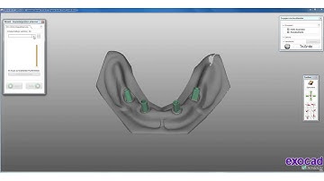 EXOCAD TUTORIAL - Dental-CAD/CAM- English Teaser -How to implement new implant Librarys