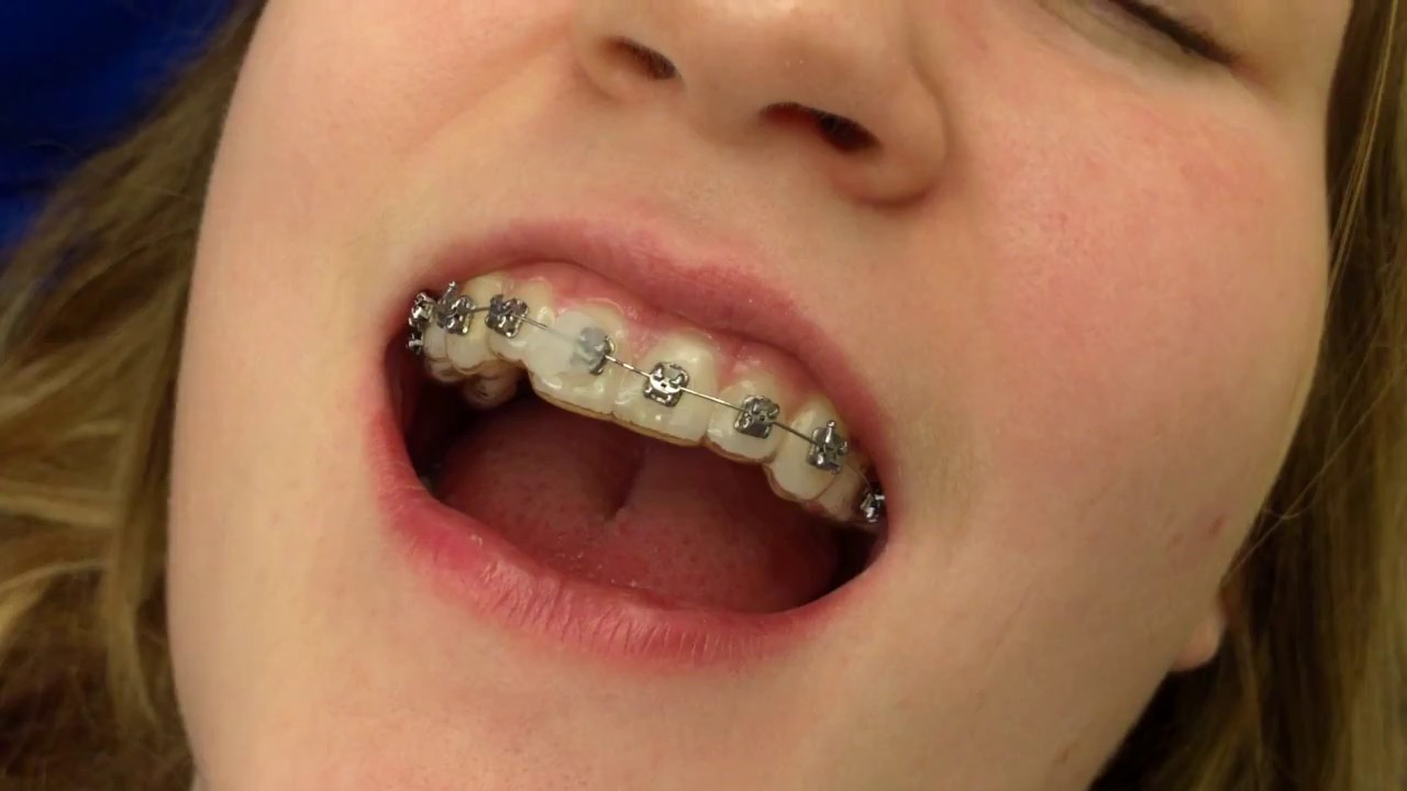 How To Temporarily Fix A Broken Bracket On Your Braces Banasiak And Nettune Orthodontic 