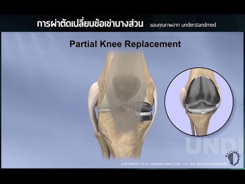 ผ่าตัดเปลี่ยนผิวข้อเข่าเทียมบางส่วน : น.ท.นพ.เอกพงษ์ โกมณหิรัณย์ โรงพยาบาลสุขุมวิท