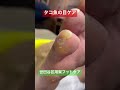 タコ魚の目ケア