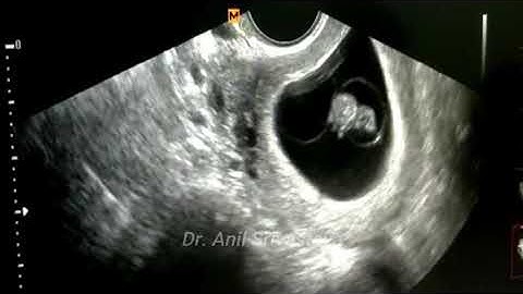 DICHORIONIC TRIAMNIOTIC( DCTA) EARLY PREGNANCY