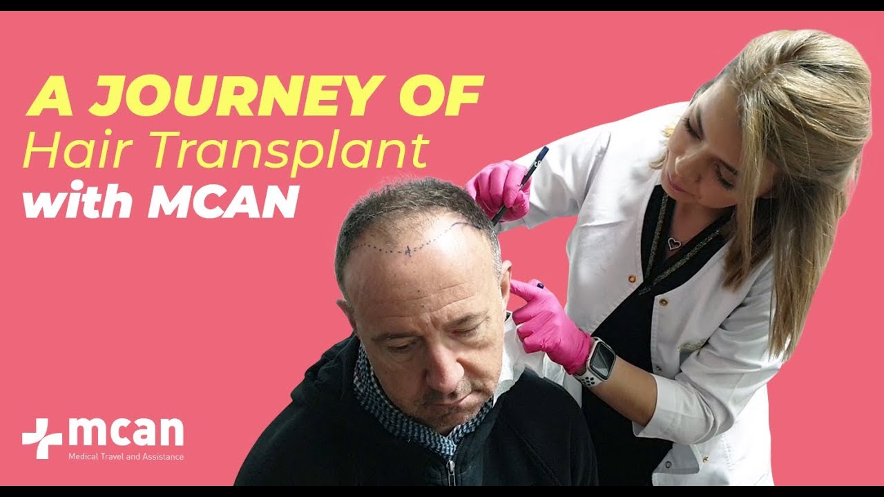 Hair Transplant in Turkey with MCAN Health