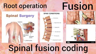 ICD 10 PCS coding Root operation: Fusion-Spinal fusion coding