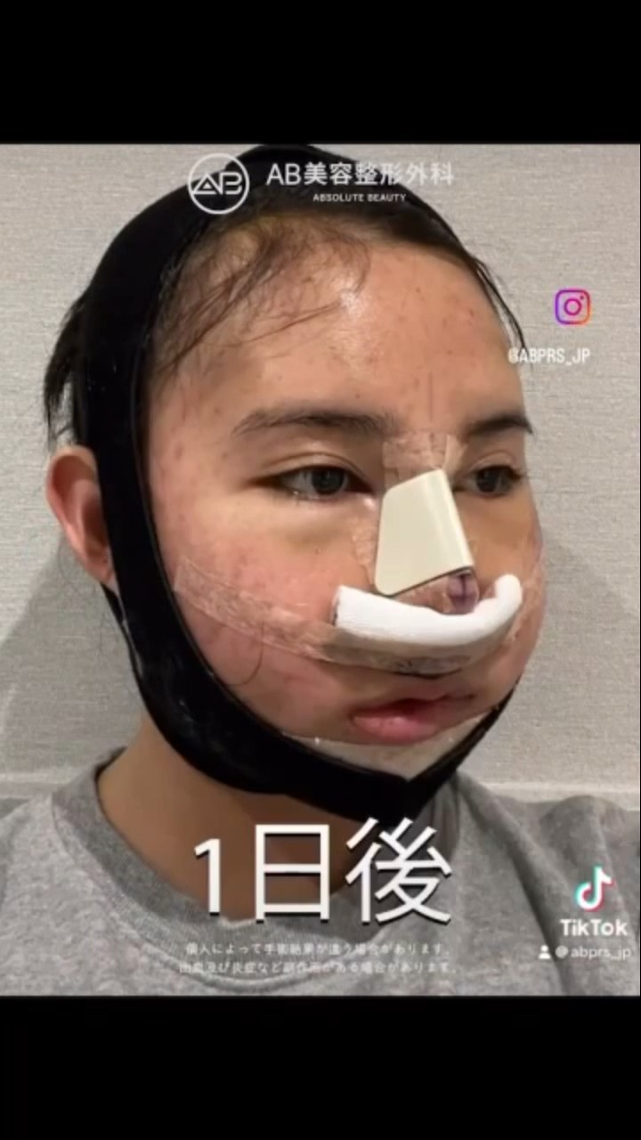 [韓国整形] 顔面輪郭整形 & 鼻整形 #ab美容外科