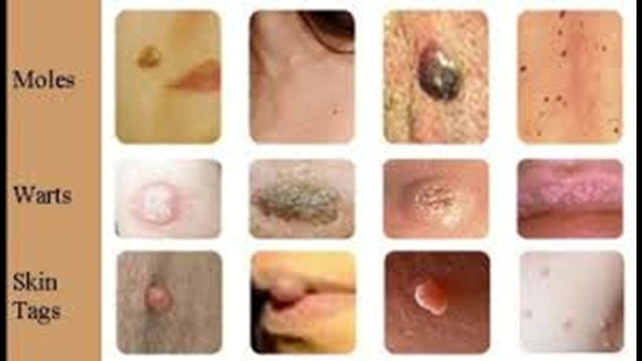 REMOVING WARTS AND SKIN TAGS EASILY AND PAINLESSLY YouTube