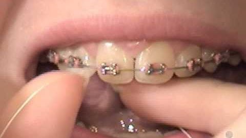Orthodontic Care Videos - Proper Flossing with Braces