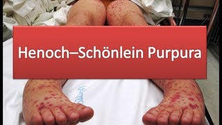 Henoch--Schönlein Purpura
