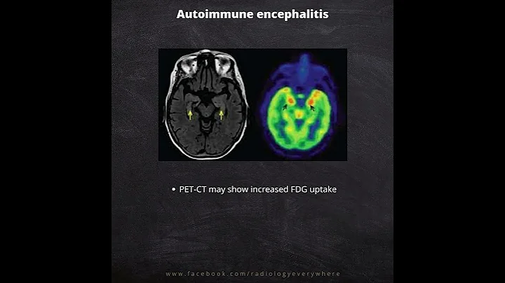 Autoimmune Encephalitis- Radiological imaging
