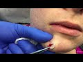 Cyst excision chin 10/4/2017