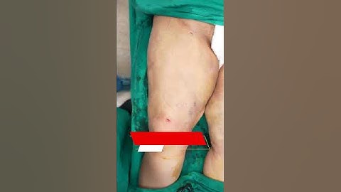 Thigh Liposuction | Thigh Liposuction cost #short #Short #shorts