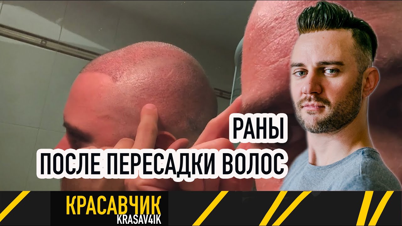 Мужская пересадка волос: фото результатов. Как выглядит донорская зона после муж