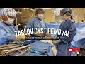 Multiple Tarlov Cyst Removal