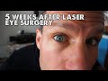 Prk vs lasik eye surgery i went with prk