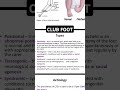 Club foot talipes Equinovarus.