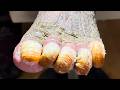 5 Toes Are Curled And Deformed, It's So Painful To See【Xue Yidao】