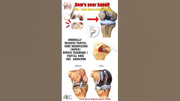 Minimally Invasive Partial Knee Resurfacing (MIPKR) - Repicci Technique | Partial Knee Doc Animation