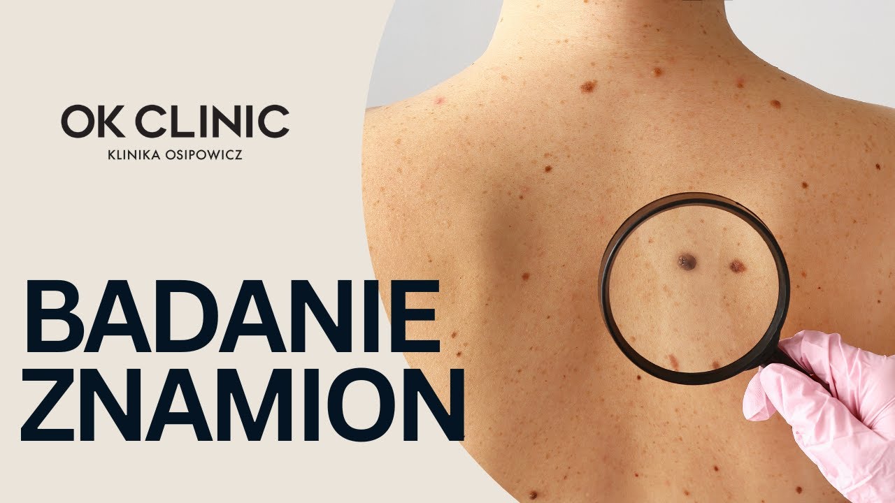 Badanie znamion - przygotowanie i zasada ABCDE