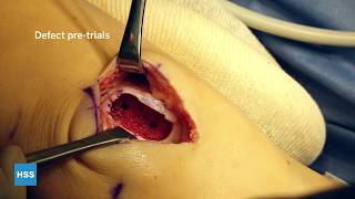 Osteochondral Allograft Transplantation Surgery: Knee Cartilage Repair (with donor transplant)