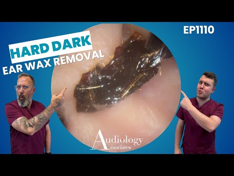 Ear Rocks How To Remove Rock Hard Ear Wax