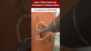 Laser Tattoo Removal At Skinaa Clinic 