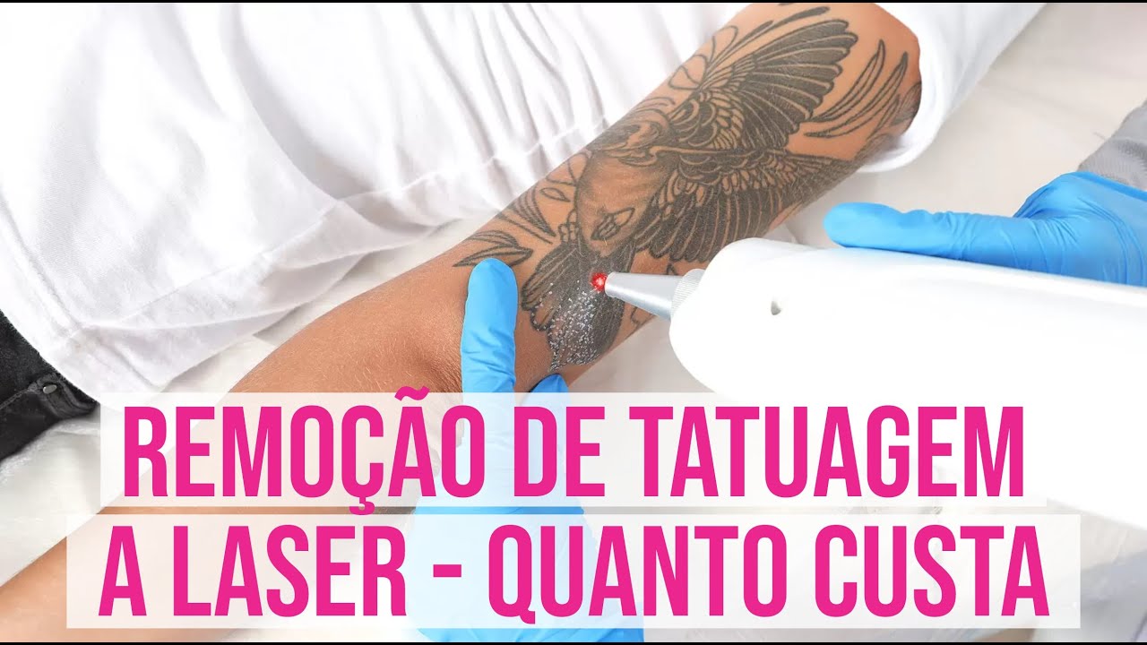 Remoção de Tatuagem a Laser Quanto Custa - YouTube