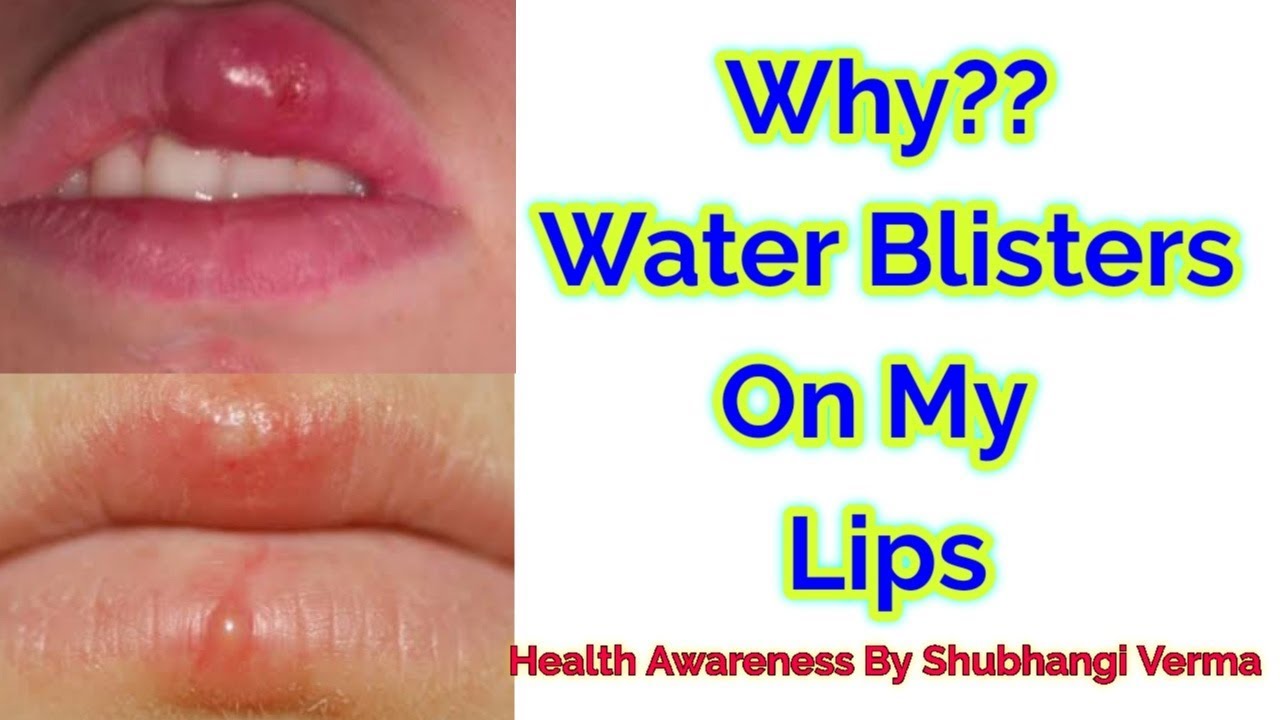 Why Water Blisters On My Lips Home Remedy For Water Blisters On