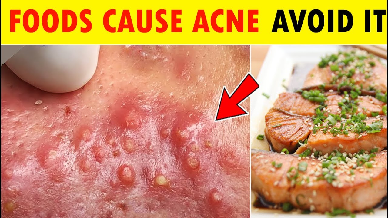 6 Food items cause acneDeep blackheads removal, blackheads extraction 2022 newest blackheads 