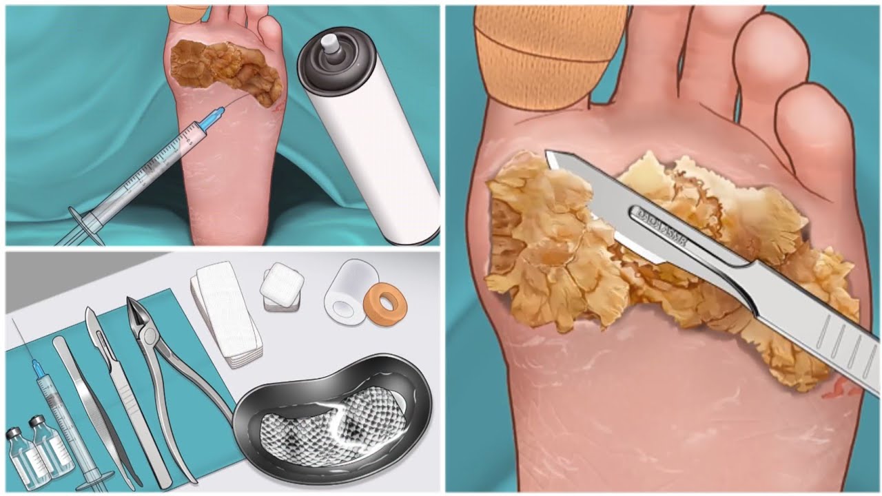 Asmr Surgery to remove large plantar warts animation corn foot