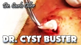 Dr. Cyst Buster - Dr. Gilmore's Epidermoid With Dr. ER Commentary